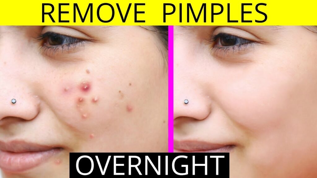 How to Remove Pimples
